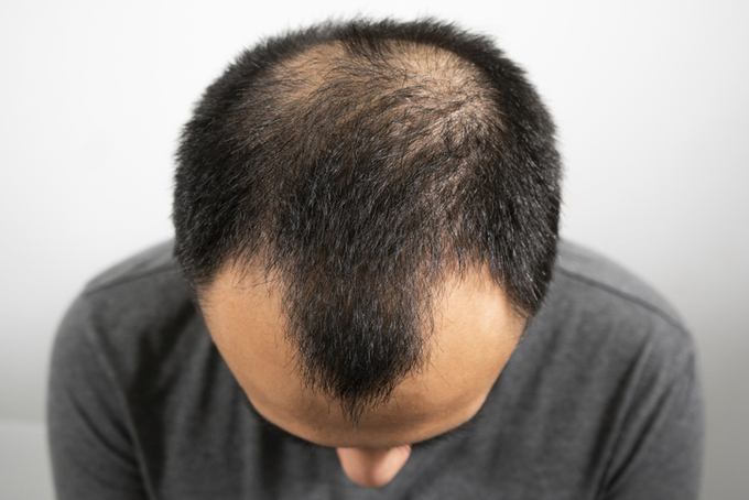 ‘Hair loss’ is still fundamentally untreatable… “Balance is important for prevention”