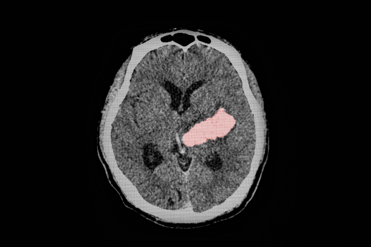 혈압·당뇨·비만… 젊을수록 더 관리해야 [김태정의 진료실은 오늘도 맑음]
